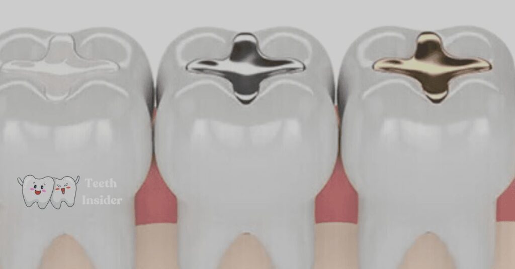 Are Composite Fillings Strong? Complete Guide