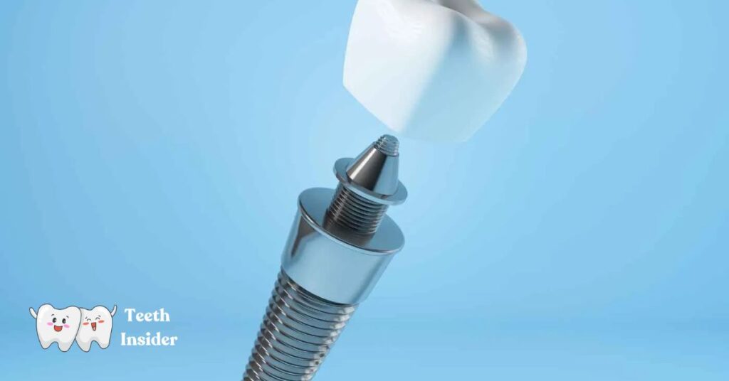 How Long Does a Single Tooth Implant Take? Discover the Procedure & Timeframe