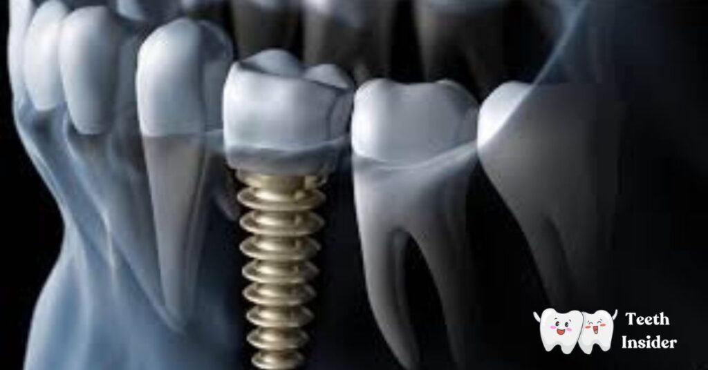 Can Failed Dental Implants Be Replaced? Complete Information