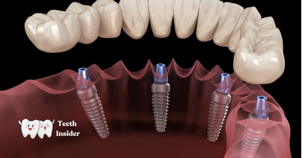 How much is all-on-4 dental implants in the UK? Complete Guidence