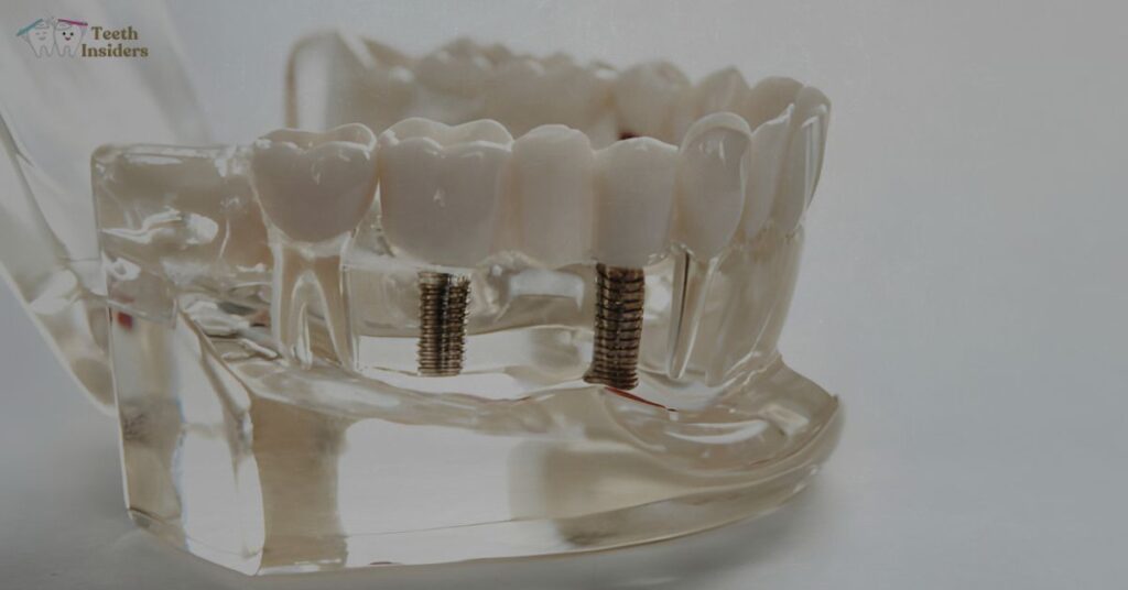 Can I Get a Government Grants for Dental Implants in the UK? Complete Guide