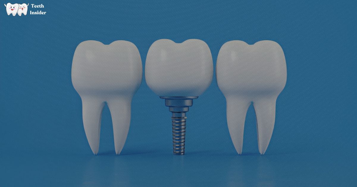 Explore the complete cost breakdown of mini dental implants in the UK