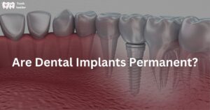 Are Dental Implants Permanent? All You Need to Know