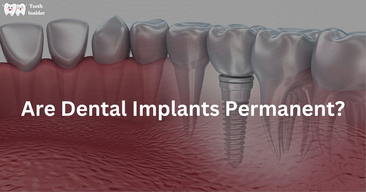 Are Dental Implants Permanent?